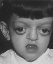 Child with Crouzon
